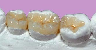 Teeth Whitening