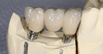 Dental Implants