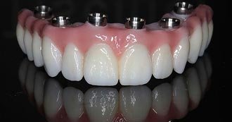 Teeth Whitening