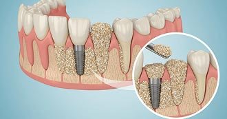 Dental Implants