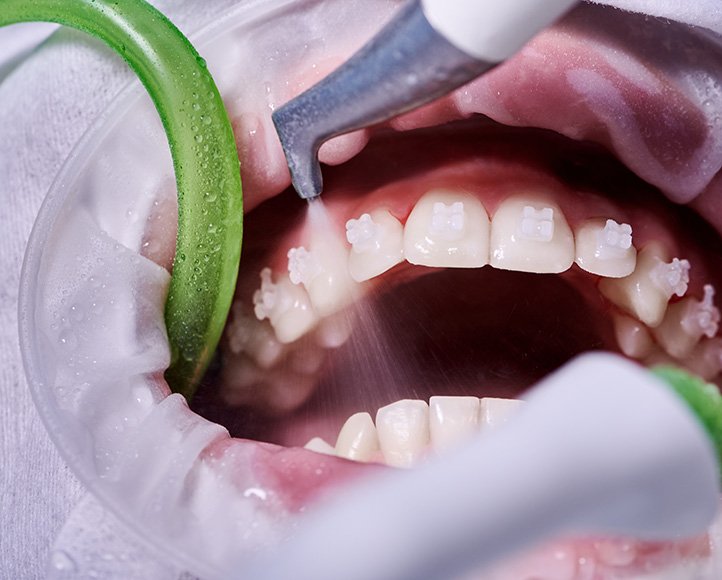Close-up of teeth being cleaned around orthodontic brackets